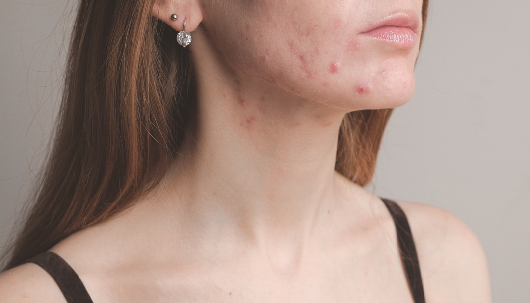 Comment lutter naturellement contre l&rsquo;acné ? Les meilleurs actifs contre les boutons