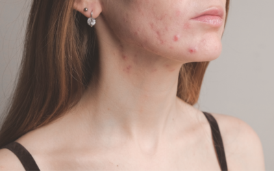 Comment lutter naturellement contre l&rsquo;acné ? Les meilleurs actifs contre les boutons